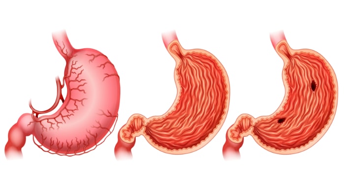 stomach mucosa - leaky gut