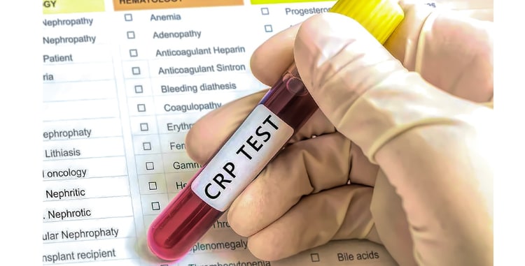 CRP: The One Blood Test You Should Beg Your Doctor To Take