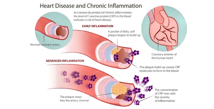 CRP and inflammation